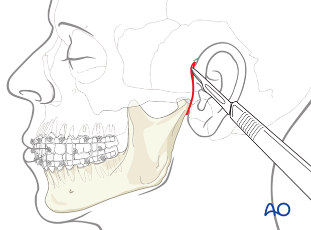 The illustration demonstrates the access and the amount of exposure