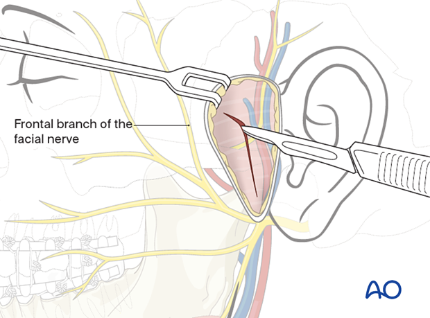 Make an oblique incision parallel to the frontal branch of the facial nerve