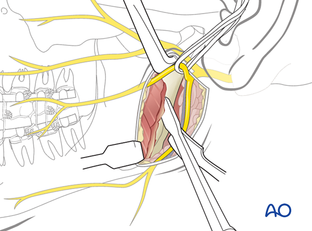 The main anatomic structures in this approach are the main trunk and branches of the facial nerve and the retromandibular vein