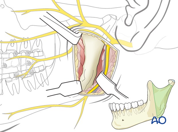 91 A080 retromandibular approaches