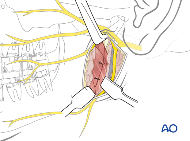 The wound is reapproximated in layers for anatomic realignment and avoidance of dead space