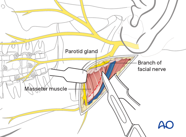 Incision through the pterygomasseteric sling