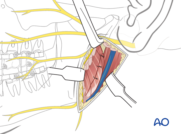 The wound is reapproximated in layers for anatomic realignment