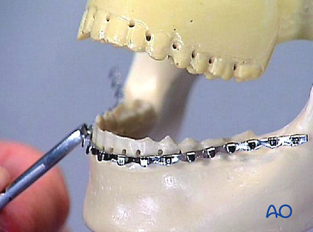 Adjusting shape of archbar