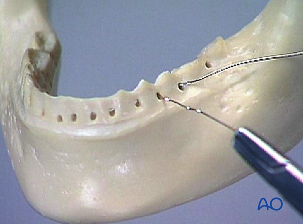 Thread it back from the lingual to the buccal side via the interdental space of the two premolars (nr. 4 and nr. 5).