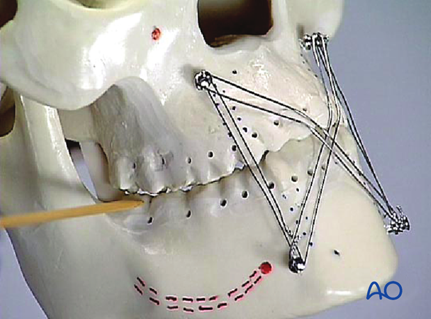 Overtightening leading to posterior open bite