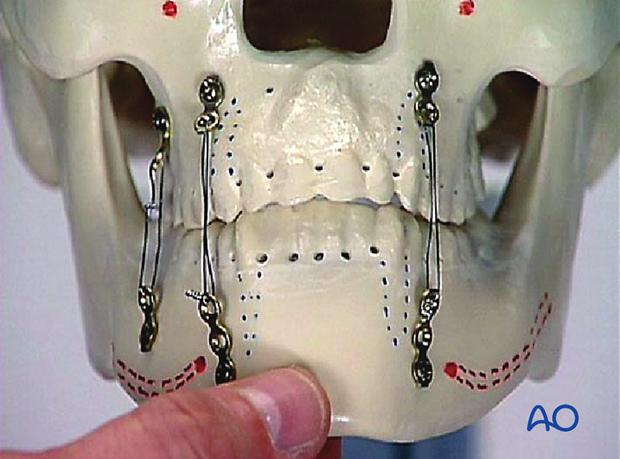 Verification of occlusion