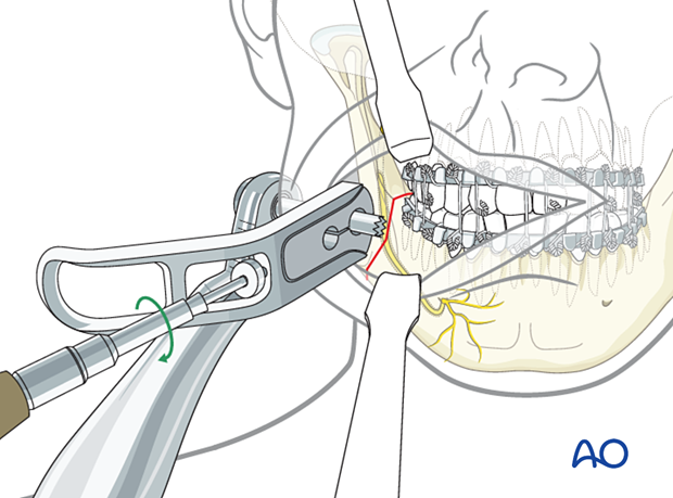 Use of straight cheek retractor