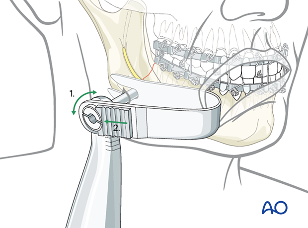 U shaped retractor