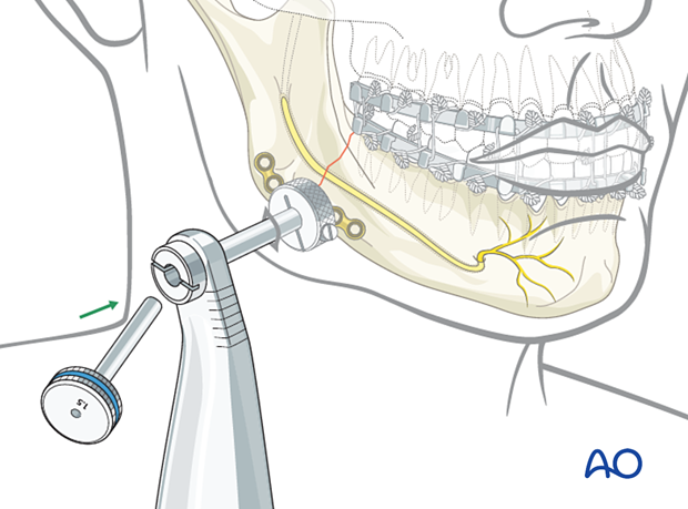 Insertion of the drill guide