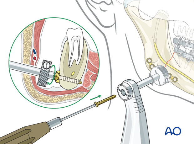 Screw insertion