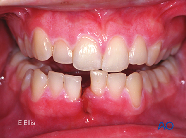 Intraoral lacerations