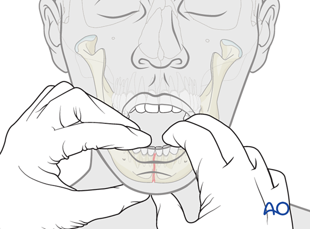 Mobility across the tooth-bearing regions indicates a fracture.