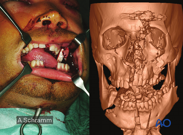 A motor vehicle accident or a gunshot wound would lead one to suspect comminution. 