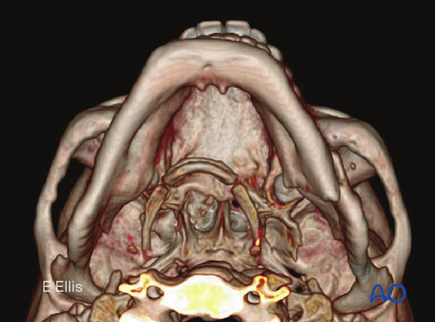 CT and Cone-beam CT