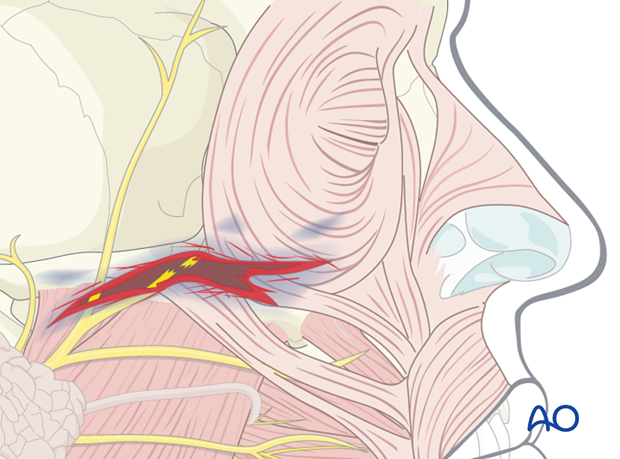 Peripheral facial nerve branch is involved