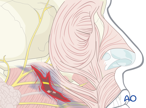 Parotid duct injury