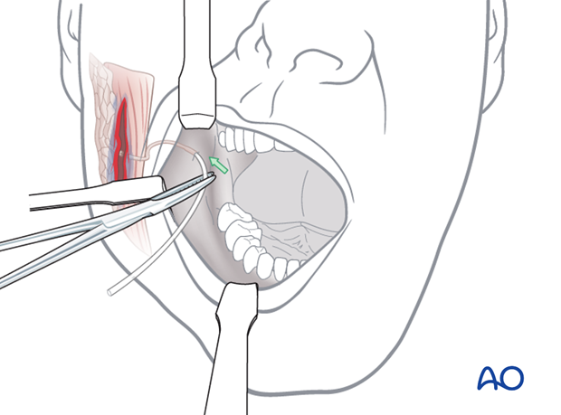 Repair of the parotid duct