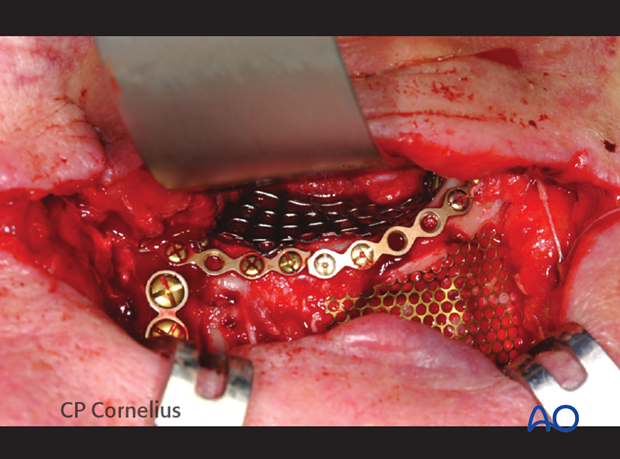 Application of osteosynthesis and orbital mesh plate