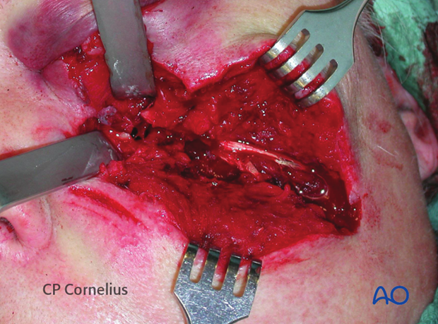 Underlying multifragmentary fracture of the infraorbital rim and the orbital floor