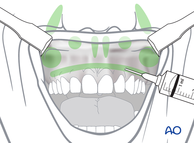 Maxillary vestibular approach