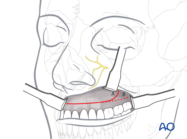 Maxillary vestibular approach