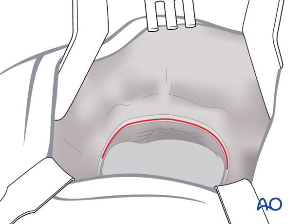 Maxillary vestibular approach