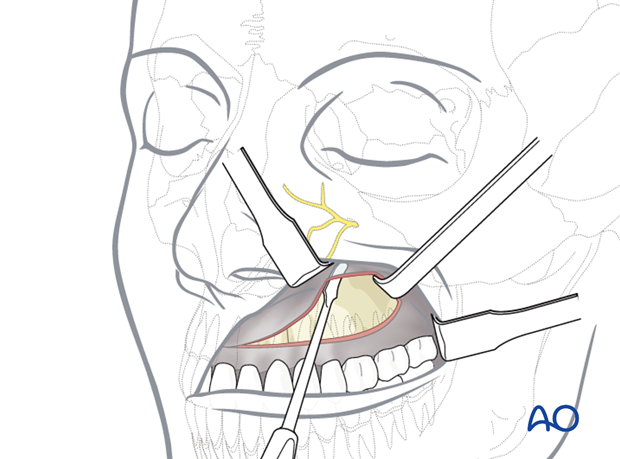 Maxillary vestibular approach