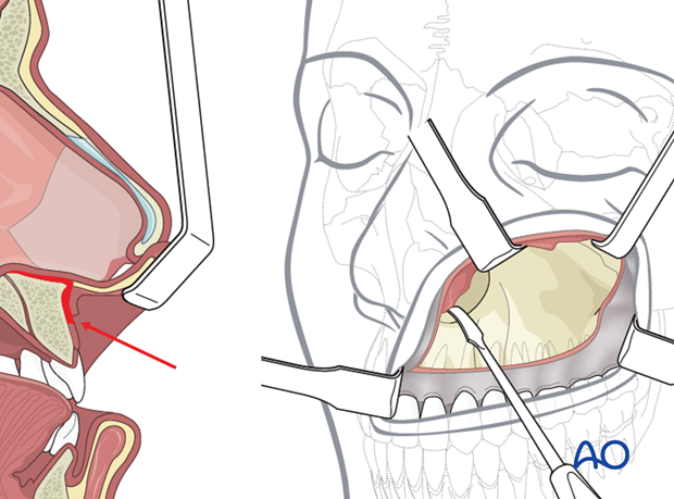 Maxillary vestibular approach