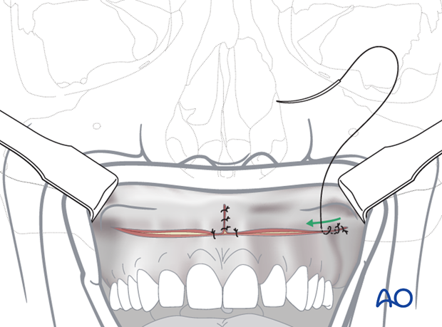 Maxillary vestibular approach