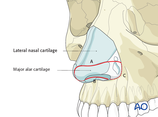 Midfacial degloving approach