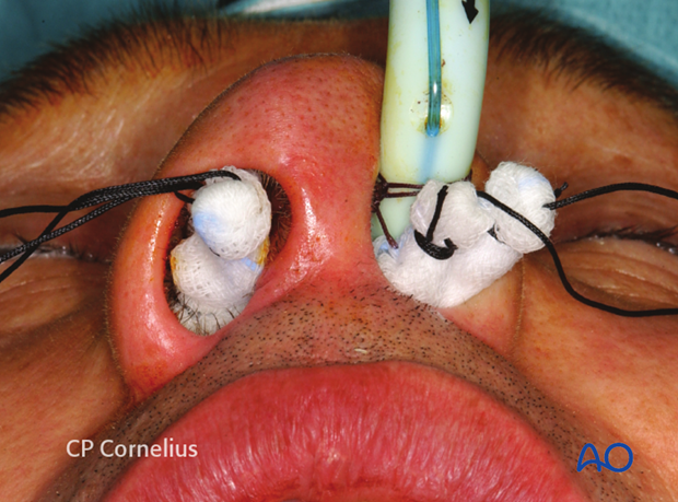 Maxillary vestibular approach