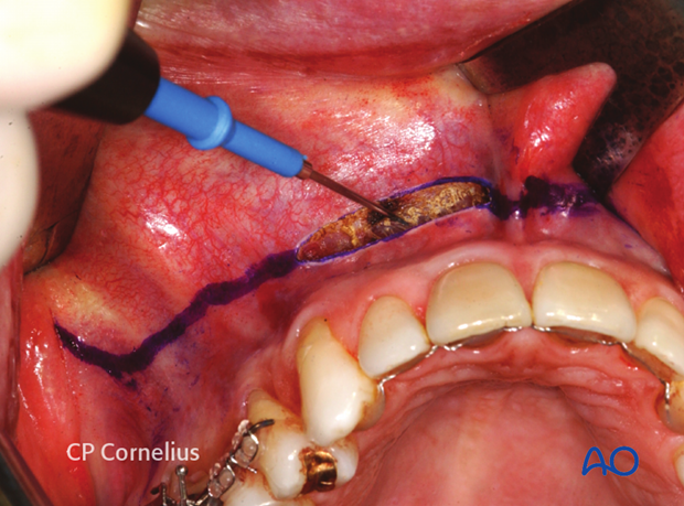 Maxillary vestibular approach