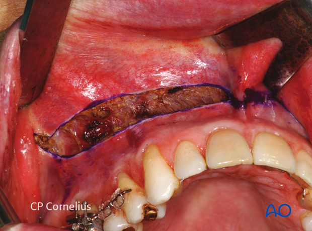 Maxillary vestibular approach