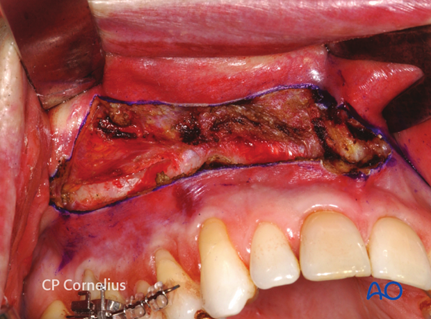 Maxillary vestibular approach