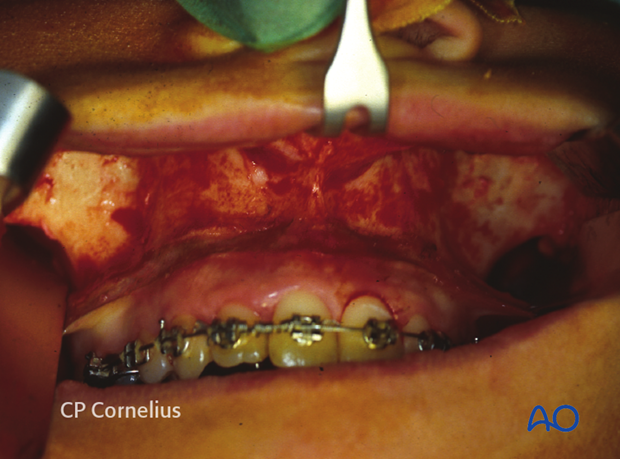 Maxillary vestibular approach