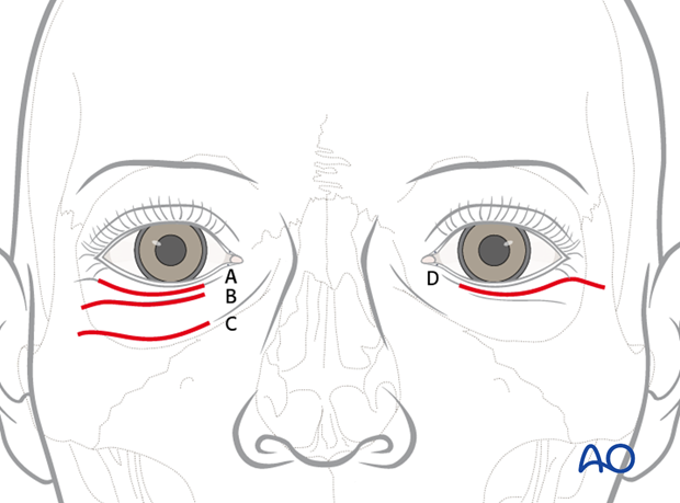 Transcutaneous lower-eyelid approach