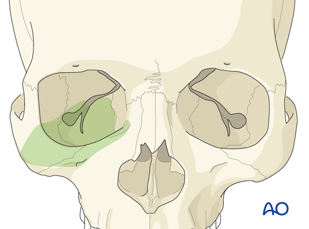 Transcutaneous lower-eyelid approach