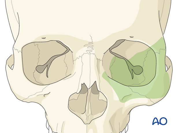 Transcutaneous lower-eyelid approach