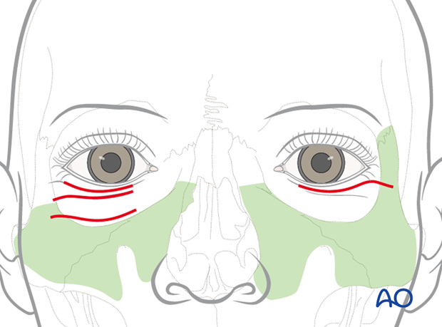 Transcutaneous lower-eyelid approach