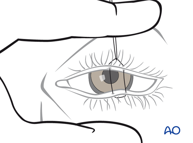 Transcutaneous lower-eyelid approach