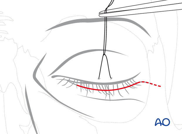 subciliary approach