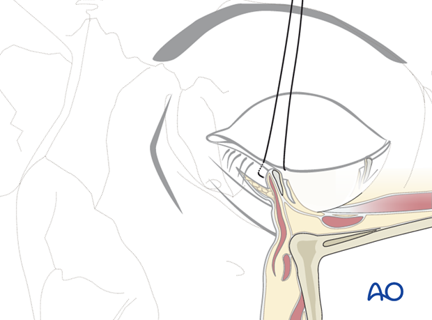 subciliary approach