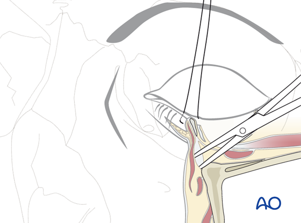 subciliary approach