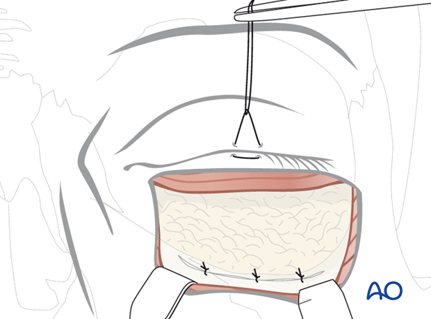 subciliary approach