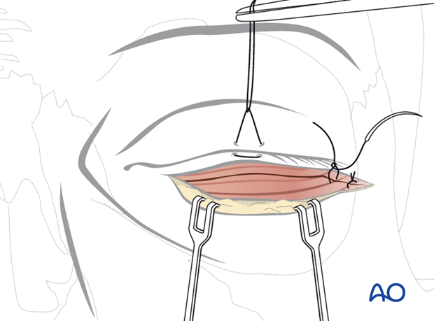 subciliary approach