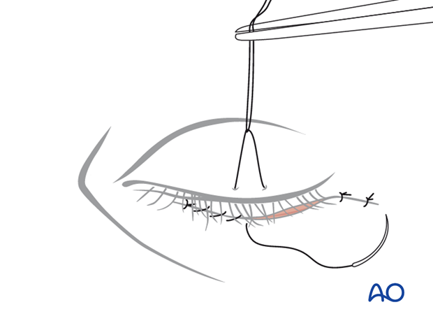 subciliary approach