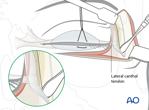 subciliary approach