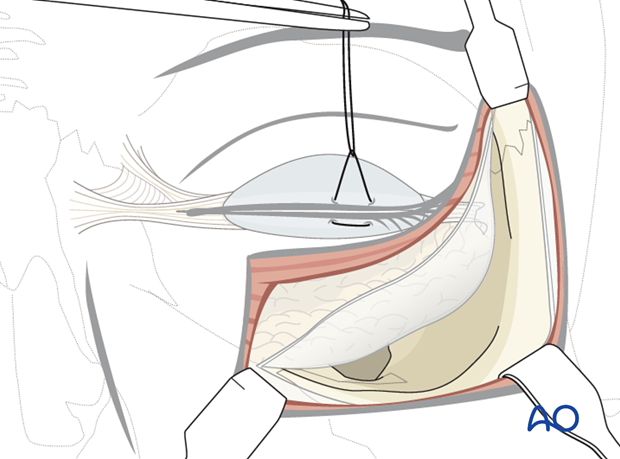 subciliary approach