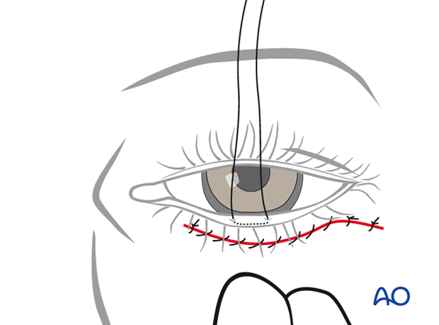 subciliary approach